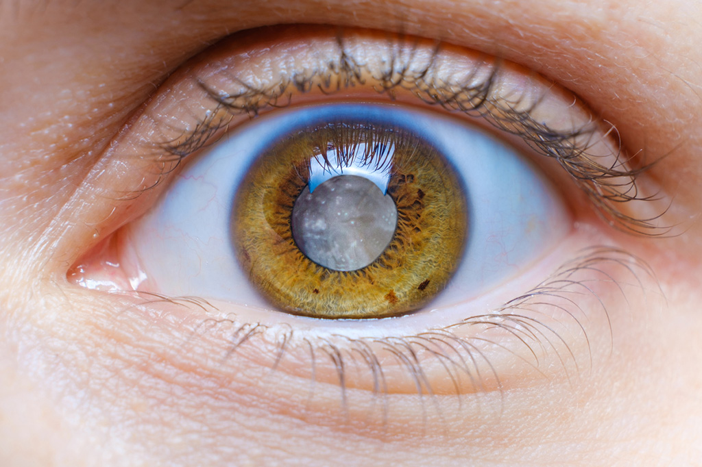 How-technology-is-revolutionizing-cataract-surgery